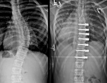 X-rays showing a spine with scoliosis before and after surgery. (Image courtesy of Shriners Hospitals for Children — Philadelphia)