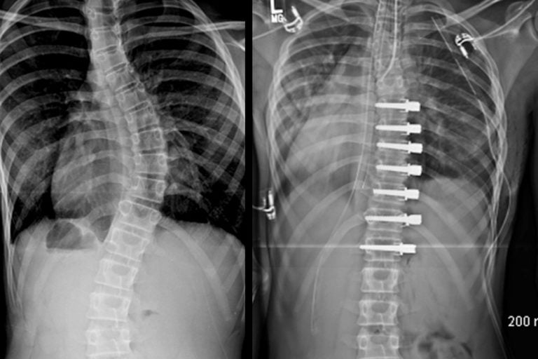 X-rays showing a spine with scoliosis before and after surgery. (Image courtesy of Shriners Hospitals for Children — Philadelphia)