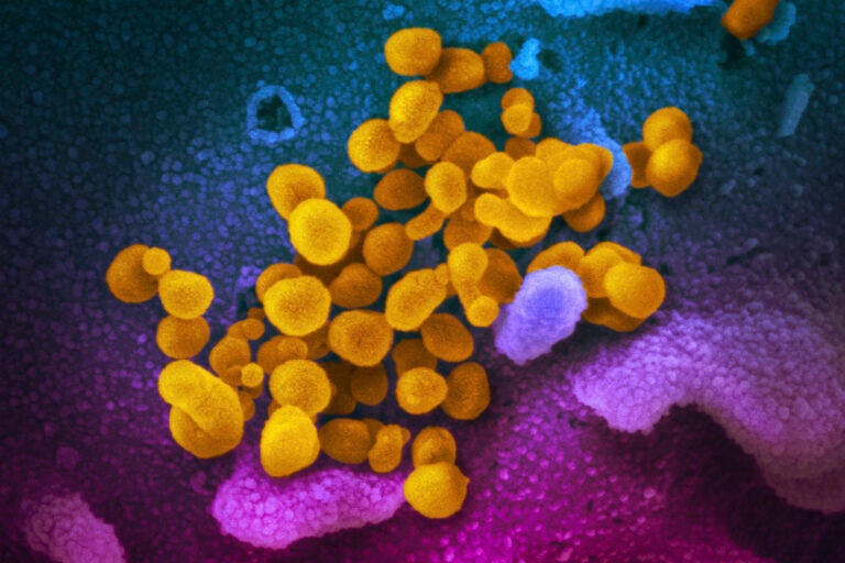 This undated electron microscope image made available by the U.S. National Institutes of Health in February 2020 shows the Novel Coronavirus SARS-CoV-2, yellow, emerging from the surface of cells, blue/pink, cultured in the lab. (NIAID-RML via AP, File)