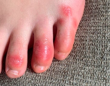 This April 3, 2020 photo provided by Northwestern University shows discoloration on a teenage patient's toes at the onset of the condition informally called 