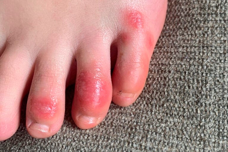 covid-toes-other-rashes-latest-possible-rare-virus-signs-whyy