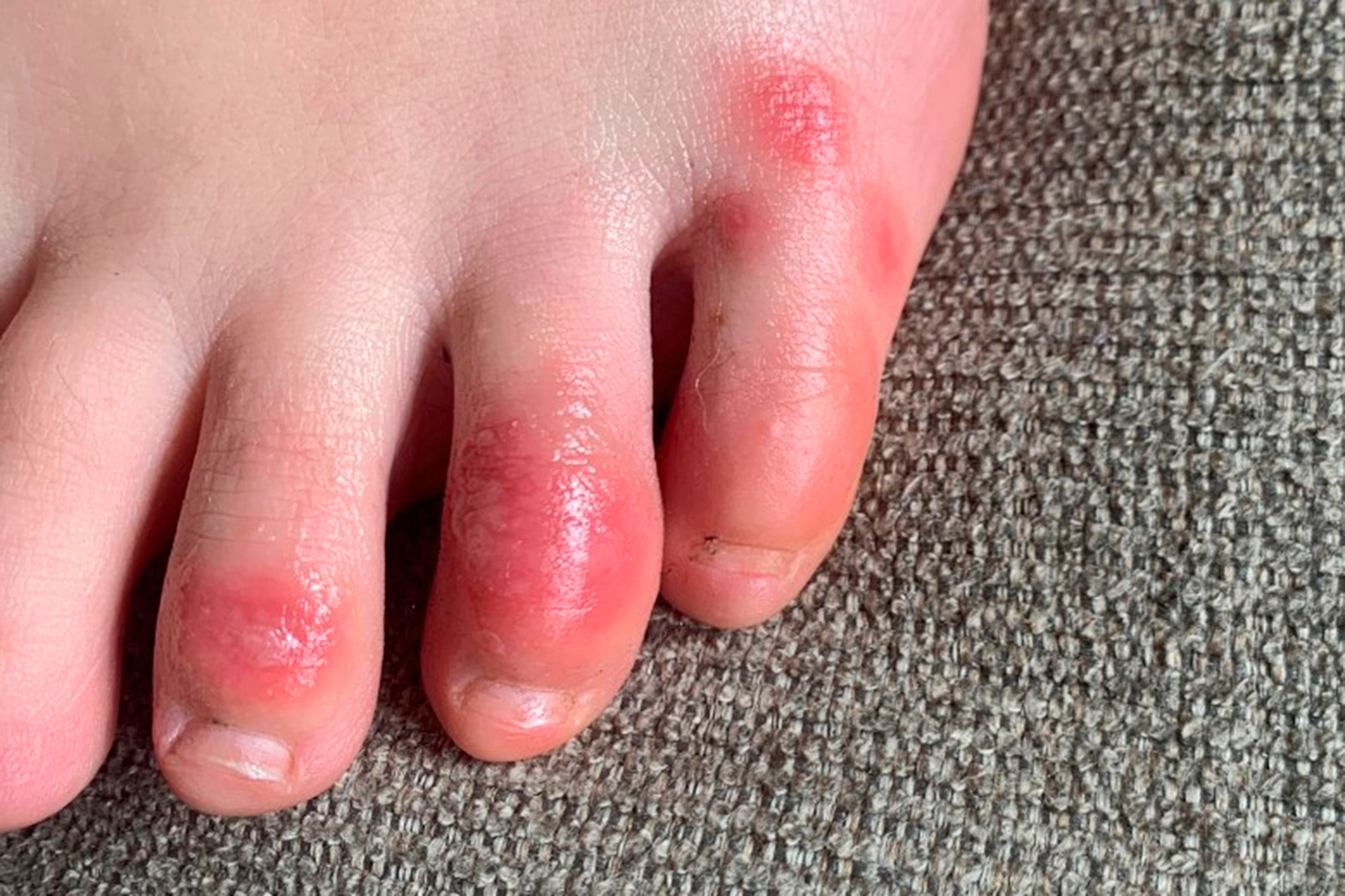 Ray butik Mathis COVID toes,' other rashes latest possible rare virus signs - WHYY