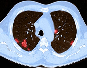 A CT Scan of the chest of a 66-year-old male reveals patchy rounded hazy spots throughout the lungs. He had tested positive for the novel coronavirus and experienced shortness of breath.