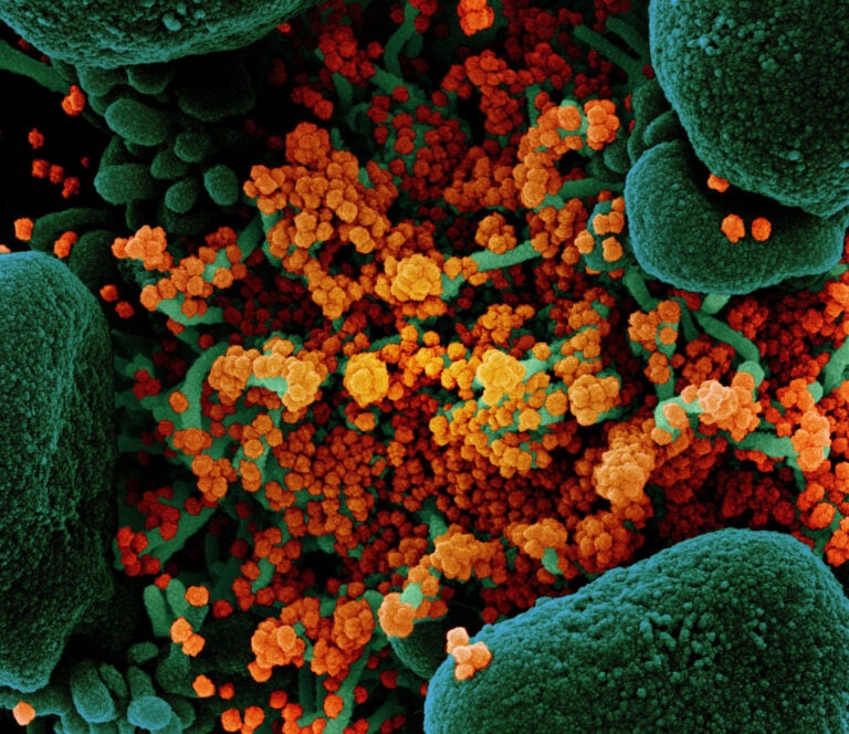 A colorized scanning electron micrograph of a cell (green) heavily infected with particles (orange) from the virus that causes COVID-19, isolated from a patient sample. (NIAID)