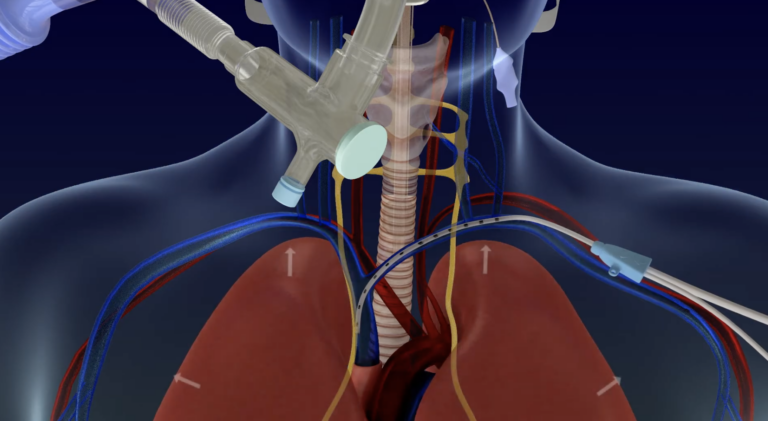 Through a catheter (on the right), the Lungpacer sends small electrical signals to the nerves to coax the diaphragm into action while the patient is on the ventilator. (Screenshot via Lungpacer Medical Inc.)
