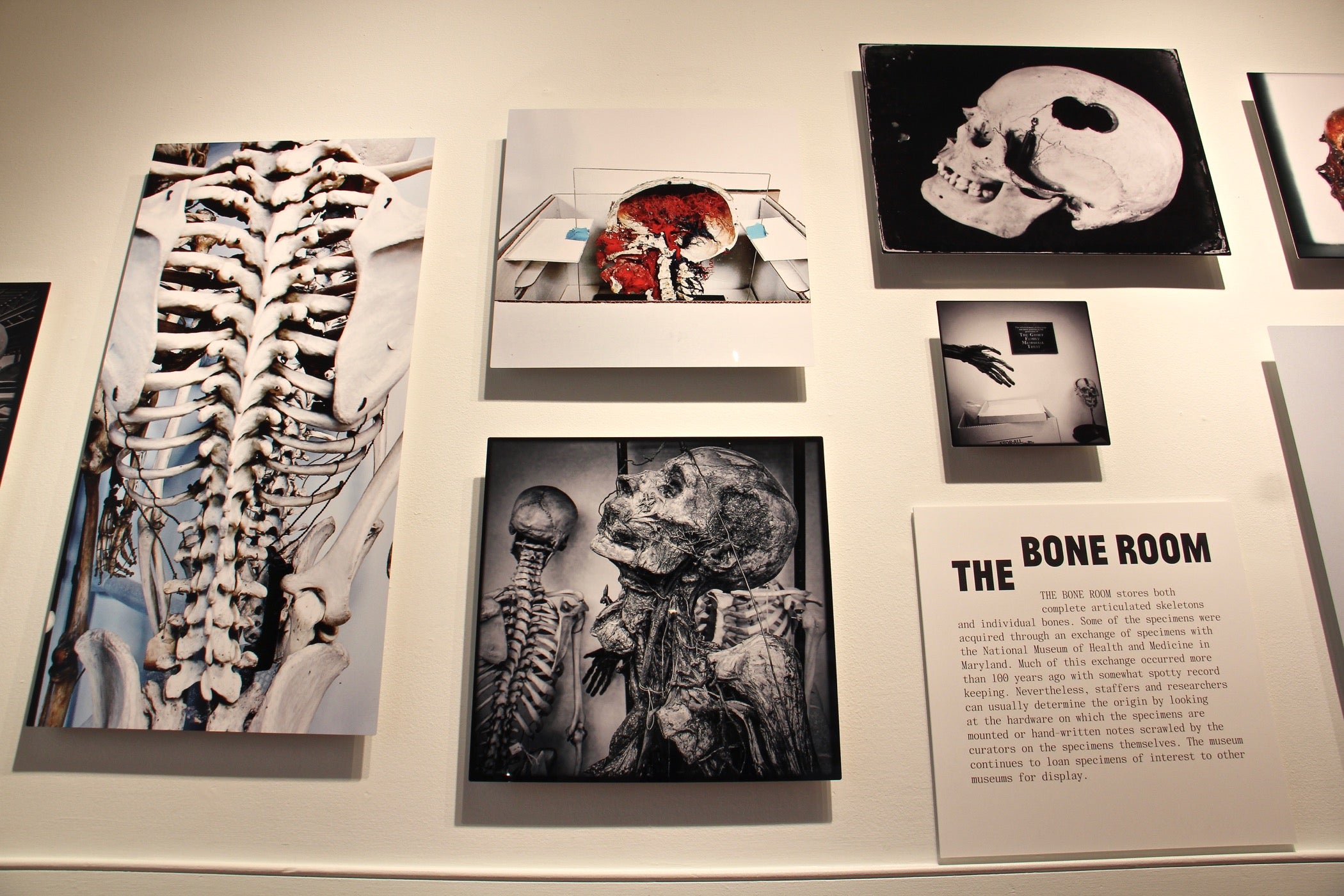 Mütter Museum of The College of Physicians of Philadelphia - The photograph  from earlier, shown again on the left, is the skeleton of a woman who wore  a corset that caused deformation