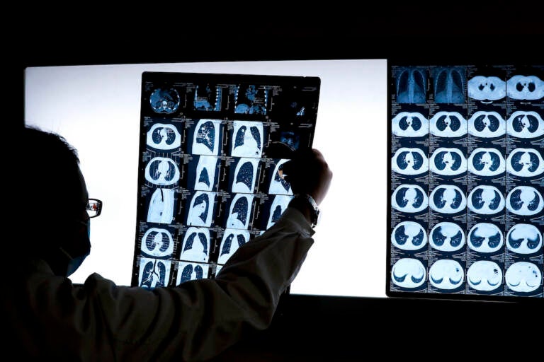 In this Thursday, Dec. 8, 2016 photo, Chinese doctor Peng Limei looks at a CT scan of a lung cancer patient at the Jingdong Zhongmei private hospital in Yanjiao, China's Hebei Province. As China considers a nationwide ban on smoking indoors, the fight is well underway in Beijing, which banned smoking in restaurants and other public places 18 months ago. Zealous volunteers and anti-smoking advocates have made some headway against millions of occasionally intransigent smokers and the state-run cigarette monopoly, a large and powerful force in China’s government and economy