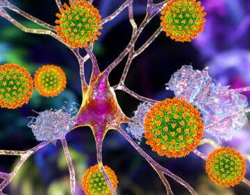A conceptual computer illustration showing coronaviruses damaging neurons and amyloid plaques in brain tissue