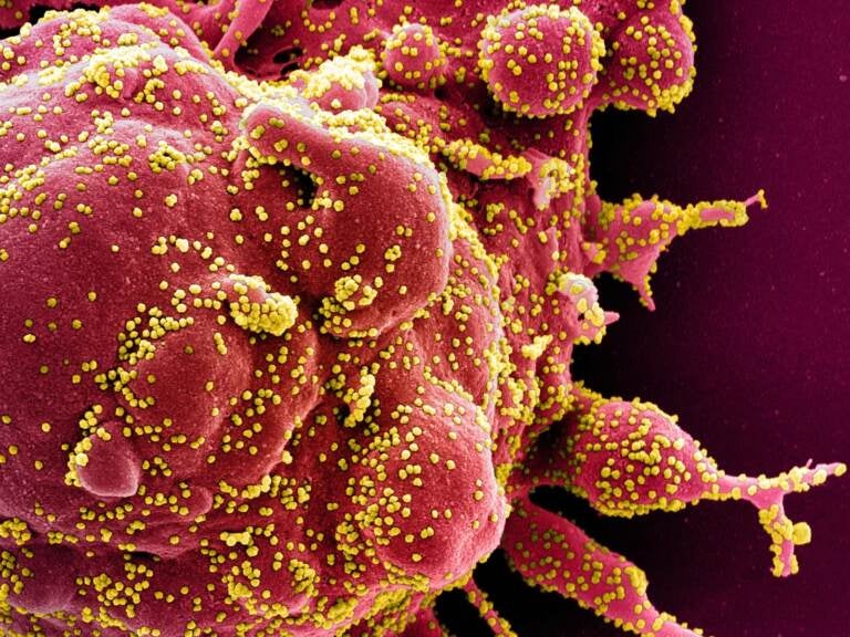 Colorized scanning electron micrograph of an apoptotic cell (red) heavily infected with SARS-COV-2 virus particles (yellow), isolated from a patient sample. Image captured at the NIAID Integrated Research Facility (IRF) in Fort Detrick, Maryland. (Science Source)