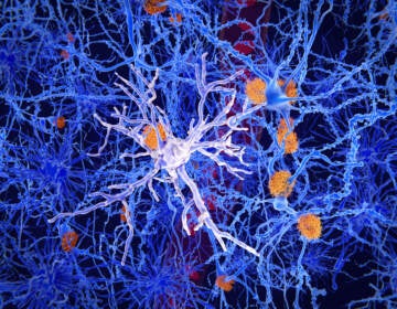 Microglia are specialized macrophages that restrain the accumulation of ß-amyloid (plaques in orange). On the other side, once activated, they can have harmful influences in Alzheimer's disease, segregating inflammatory factors and mediating the engulfment of synapses.