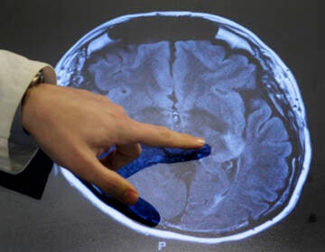 Dr. Paul Nyquist points to spots of possible damage caused by a stroke brain scan. Over the past 30 years, strokes among adults 49 and younger have increased in some parts of the U.S. (Patrick Semansky/AP)