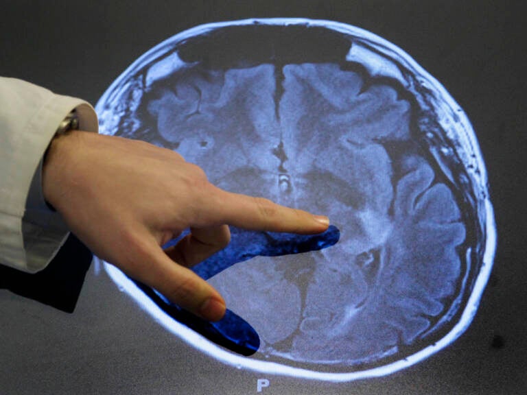Dr. Paul Nyquist points to spots of possible damage caused by a stroke brain scan. Over the past 30 years, strokes among adults 49 and younger have increased in some parts of the U.S. (Patrick Semansky/AP)