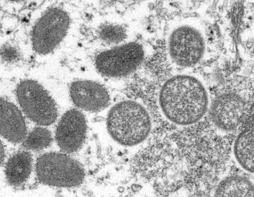 An electron microscope image shows monkeypox virus particles.
