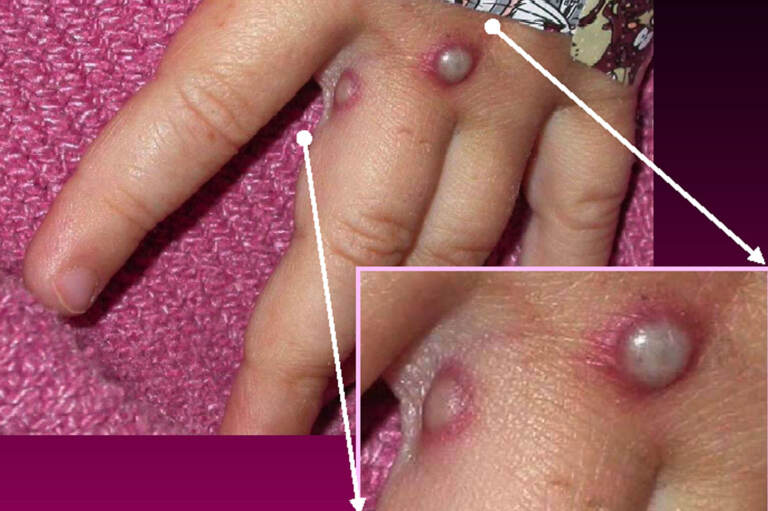 Symptoms of a monkeypox virus are shown on a patient's hand
