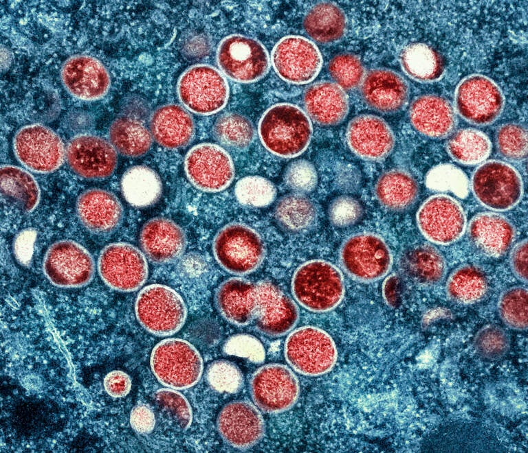 Who Is Most Vulnerable To The Monkeypox Virus?