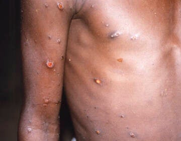 A patient with monkeypox lesions