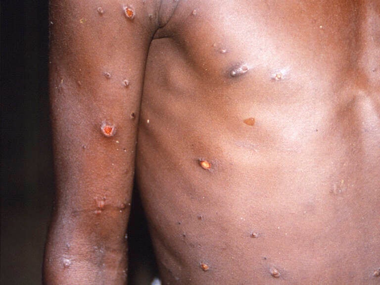 A patient with monkeypox lesions