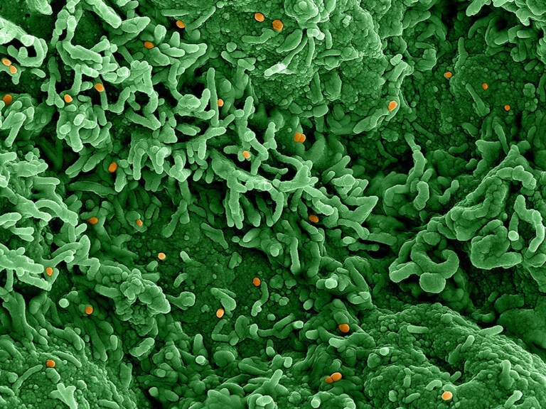 Dots which show the monkeypox virus cells are orange in a sea of green cells that are infected with the virus.