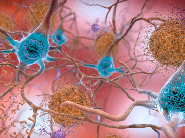 Cells in an Alzheimer’s affected brain, with abnormal levels of the beta-amyloid protein clumping together to form plaques, brown, that collect between neurons and disrupt cell function