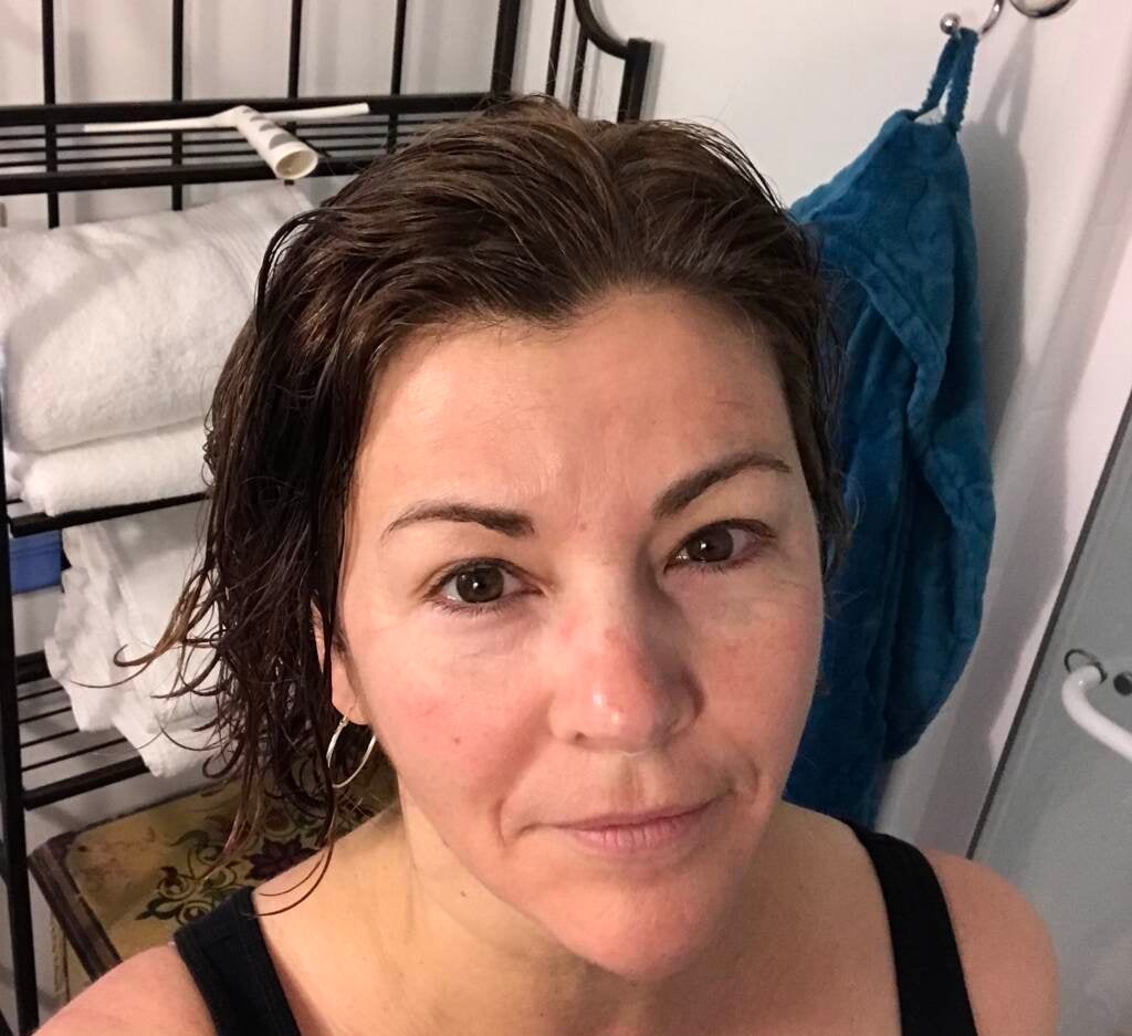 Maiken Scott's skin the day after receiving a microneedling treatment based on stem cells. 