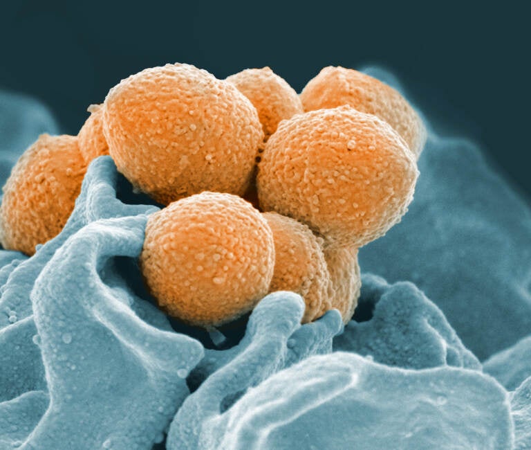 This handout image provided by the National Institute of Allergy and Infectious Diseases shows an electron microscope image of Group A Streptococcus (orange) during phagocytic interaction with a human neutrophil (blue)
