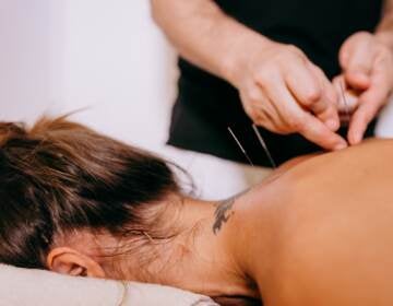 Hands inserting needles on persons back