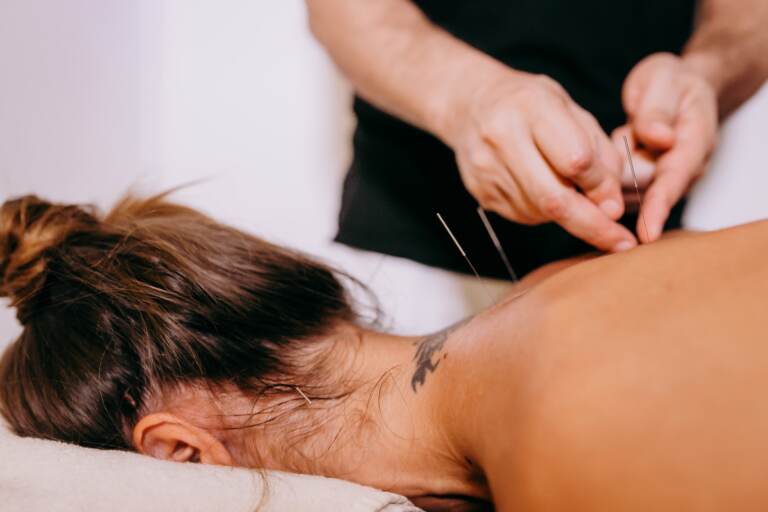 Hands inserting needles on persons back