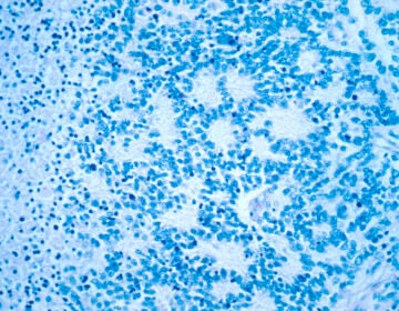 a neuroblastoma with rosette formation as seen in a microscope