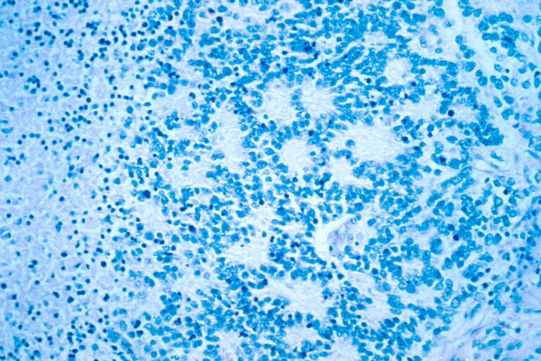 a neuroblastoma with rosette formation as seen in a microscope