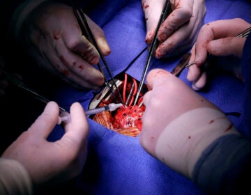 In this Nov. 28, 2016 photo, Dr. Si Pham, bottom left, injects stem cells into Josue Salinas Salgado during open heart surgery at the University of Maryland Medical Center in Baltimore. (AP Photo/Patrick Semansky)