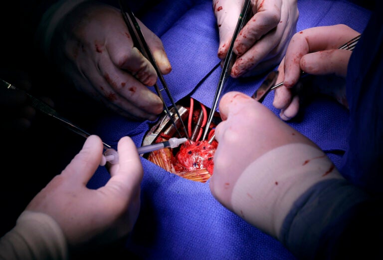 In this Nov. 28, 2016 photo, Dr. Si Pham, bottom left, injects stem cells into Josue Salinas Salgado during open heart surgery at the University of Maryland Medical Center in Baltimore. (AP Photo/Patrick Semansky)