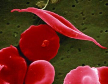 Sickle Cell disease