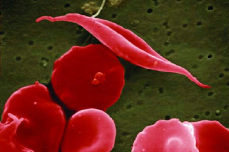 Sickle Cell disease