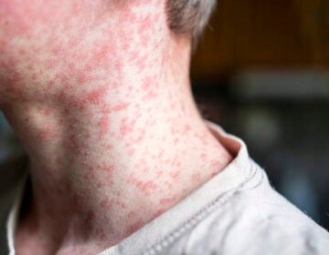 human skin covered with measles rash