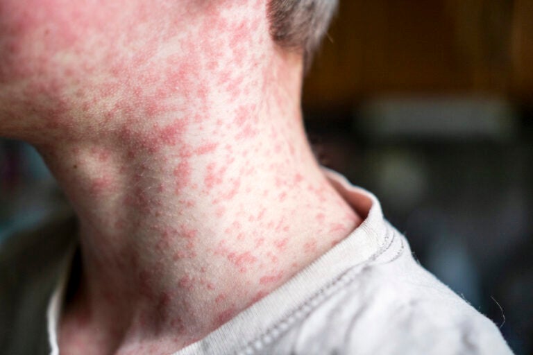 human skin covered with measles rash