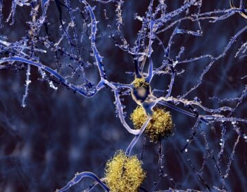 Amyloid plaque