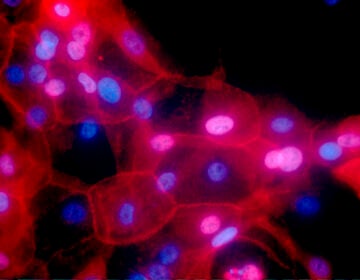 a culture of human breast cancer cells