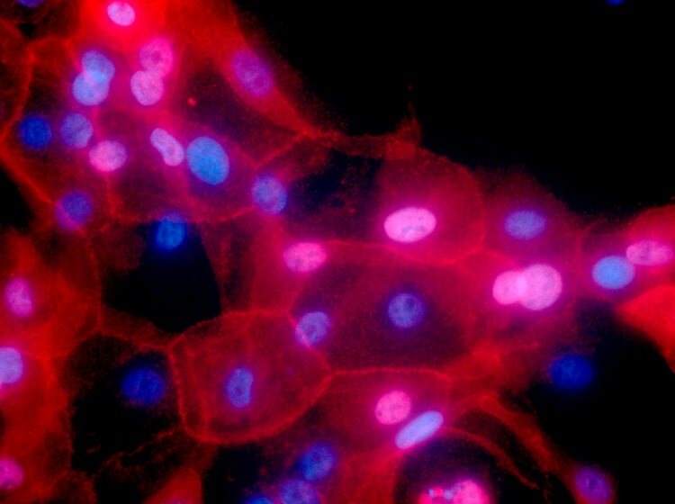 a culture of human breast cancer cells