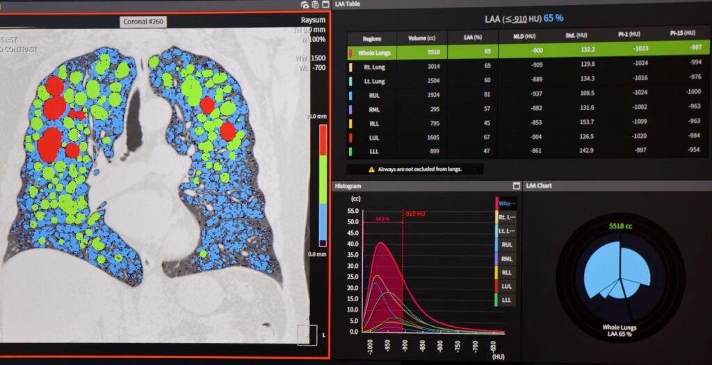 Temple Lung Center uses artificial intelligence software