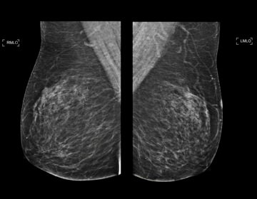 Mammogram scan showing both sides of the breast