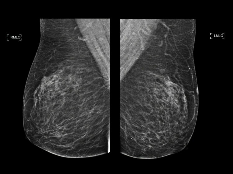 Mammogram scan showing both sides of the breast