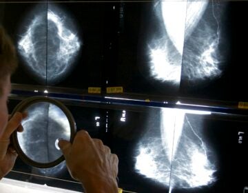 Breast Cancer Treatment A doctor is inspecting images from a mammogram.
