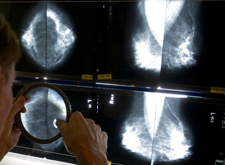 A doctor is inspecting images from a mammogram.