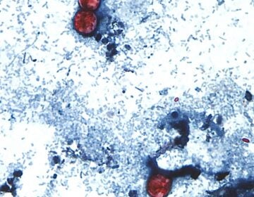 A view of a stool sample seen through a microscope with a parasite present.